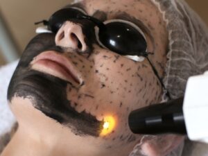 Carbon Peel (3 sesiones)