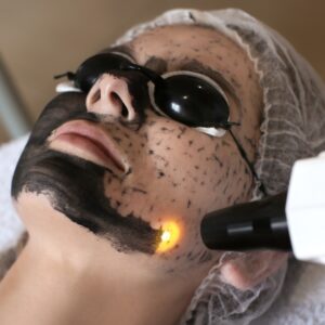 Carbon Peel