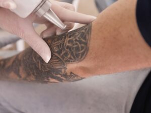 Eliminar Tatuajes