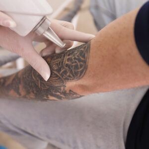 Eliminar Tatuajes
