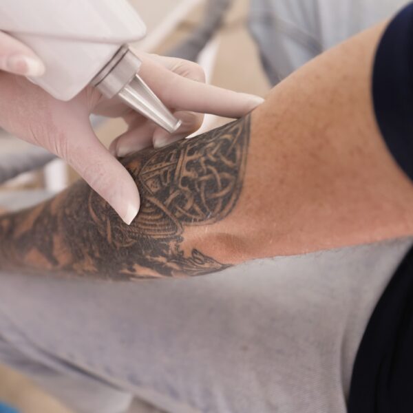 Eliminar Tatuajes